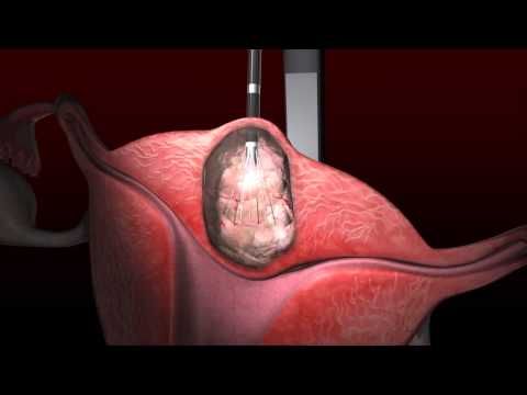 radiofrequency ablation for fibroids reviews